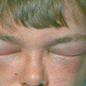 allergi-for-hvepsestik-bistik.jpg