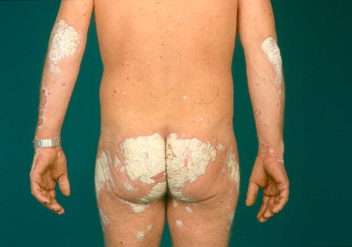 psoriasis_1-jpg.jpg