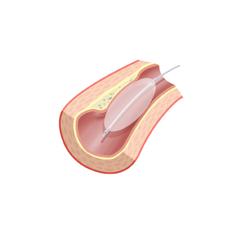 Illustration af ballonudvidelse
