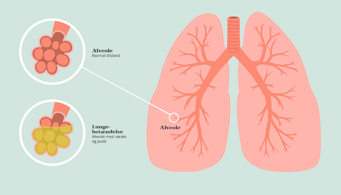 lungebetaendelse-illustration-700x400.jpg