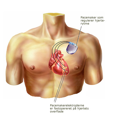 Pacemaker med pacemakerelektroder fastopereret på hjertets overfalde
