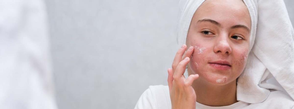 acne-behandling-istock-1366979571.jpg
