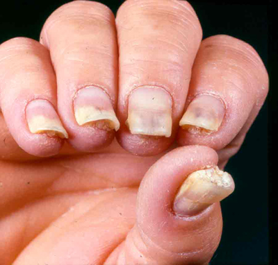 psoriasis_2-jpg.jpg