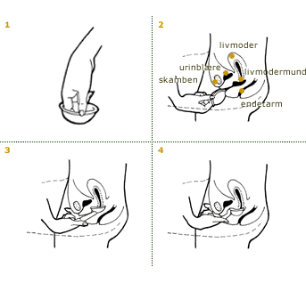 pessar-illustration.gif