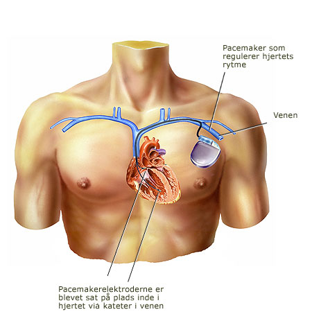 Pacemaker med pacemakerelektroder sat på plads via kateter i venen